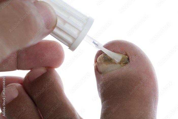 Fungus can nail toenail polish if saved wondering wear have toe toenails nails