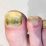 Can You Put Gel Polish on Fungal Nail?