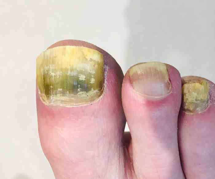 Can you put gel polish on fungal nail