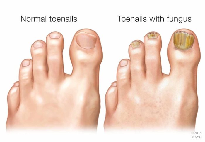 Fungal infections