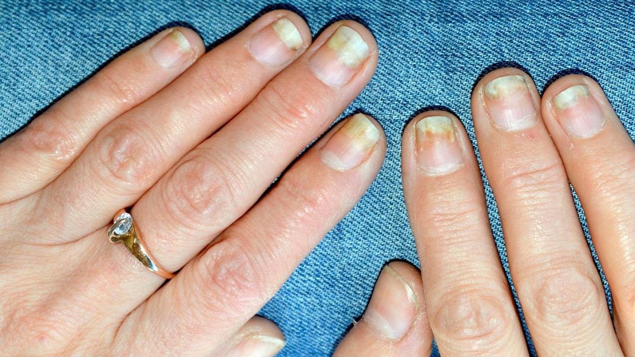 Damaged nails after gel polish