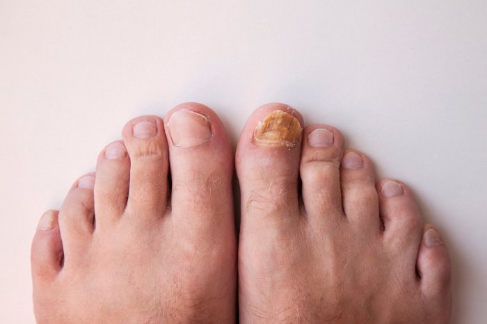 Does nail polish cause toenail fungus